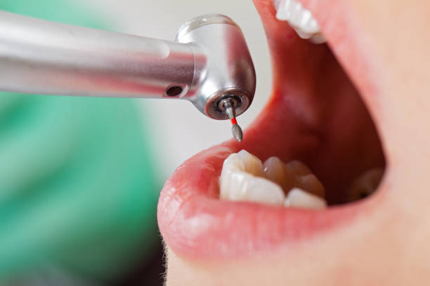 Best Emergency Broken Tooth Repair in Little Cypress, TX